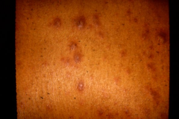 Erythema Multiforme (30)