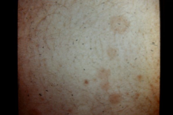 Erythema Multiforme (32)