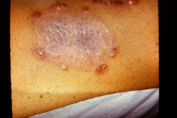 Erythema Multiforme (33)