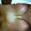 Erythema Multiforme (35)