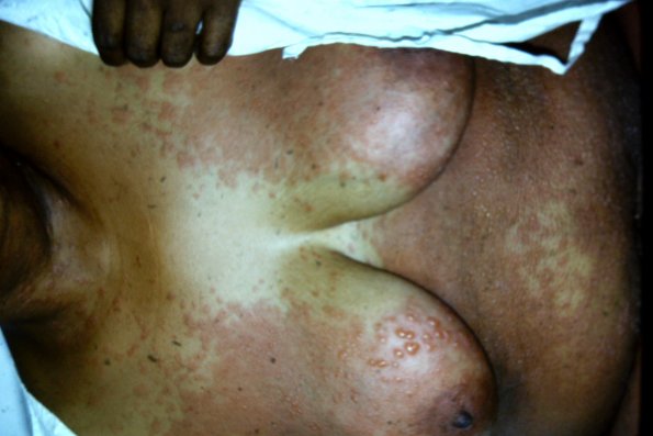 Erythema Multiforme (35)