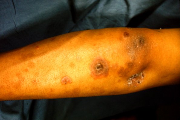 Erythema Multiforme (4)