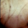 Erythema Multiforme (42)