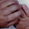 Erythema Multiforme (43)