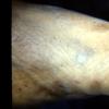 Erythema Multiforme (49)