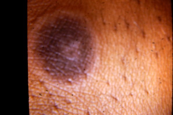 Erythema Multiforme (52)