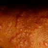 Erythema Multiforme (53)