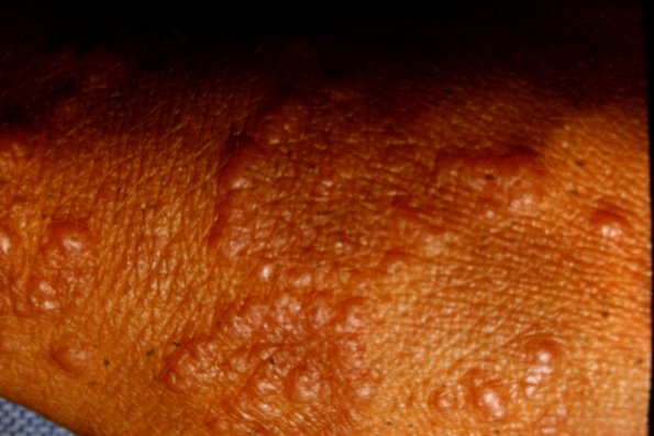 Erythema Multiforme (53)