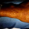 Erythema Multiforme (58)