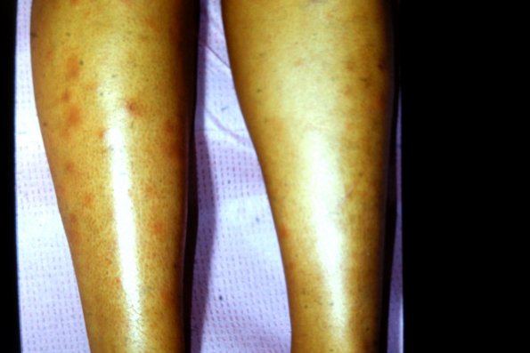 Erythema Nodosum (2)