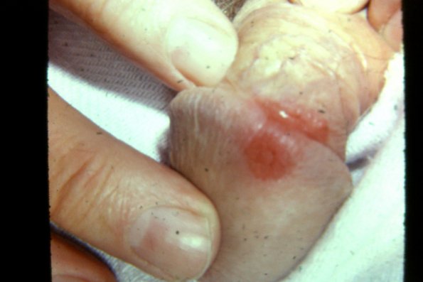 Bowen's Disease (12)