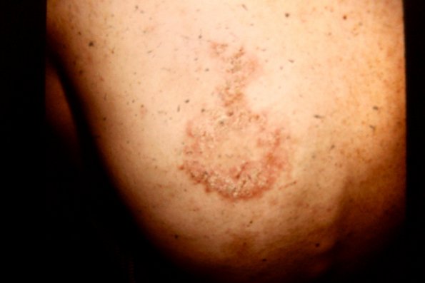 Hailey-Hailey Disease (8)