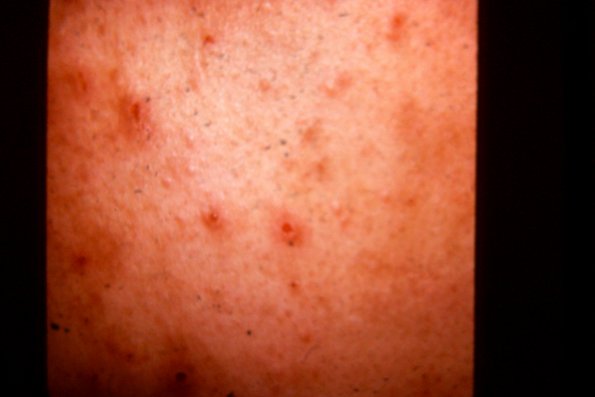 Perforating Folliculitis (7)