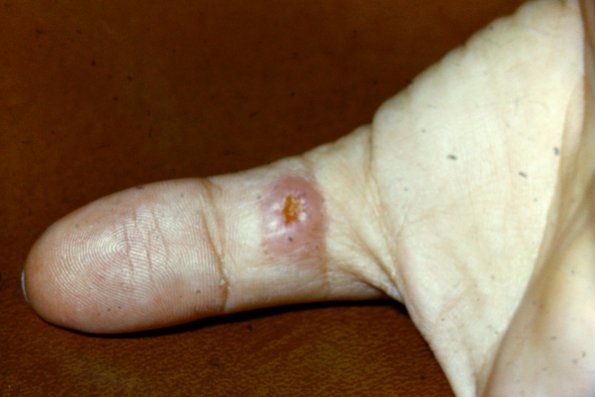 Granuloma (5)