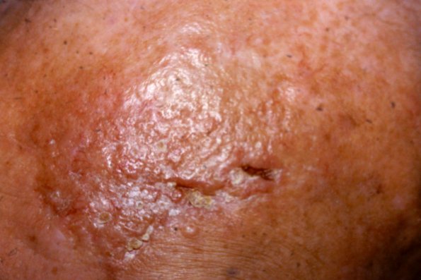 Hemangioendothelioma