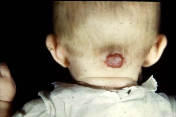 hemangioma 