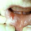 Herpes Simplex (7)