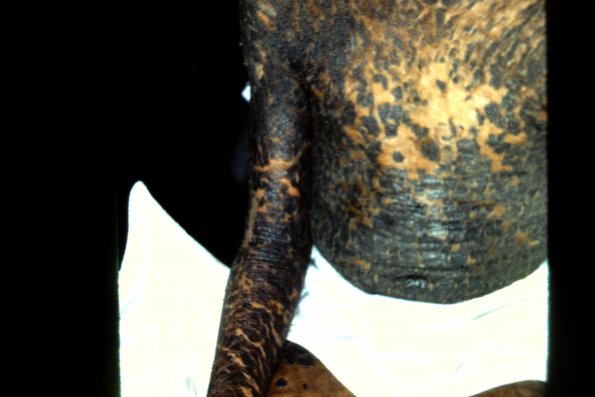 Lamellar Ichthyosis