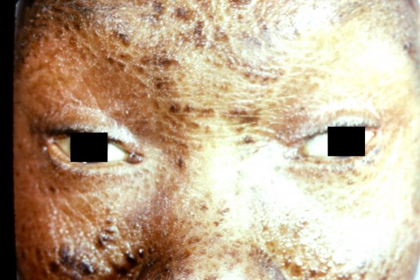 Lamellar Icthyosis Collodion Baby (2)