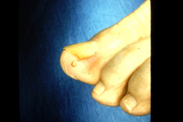 Ingrown Toenail