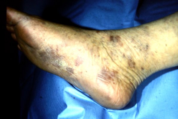 Kaposi's Sarcoma (2)