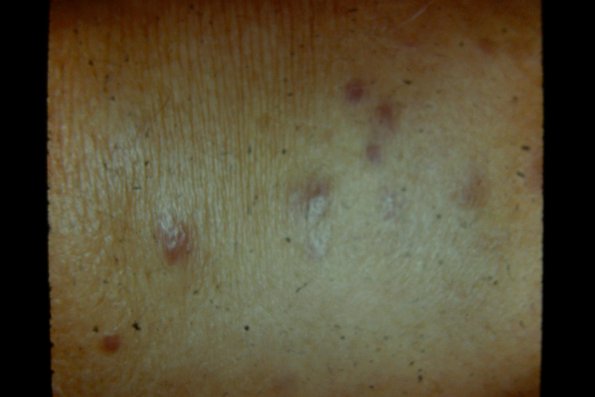 Kaposi's Sarcoma (23)