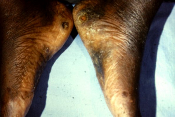 Kaposi's Sarcoma (6)