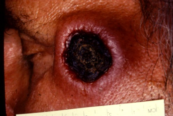 Keratoacanthoma (4)