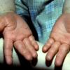 Keratoderma Palmaris (4)