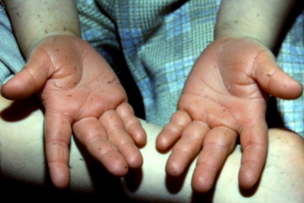 Keratoderma Palmaris (4)