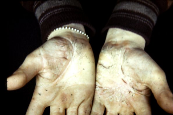 Keratoderma Palmaris (6)