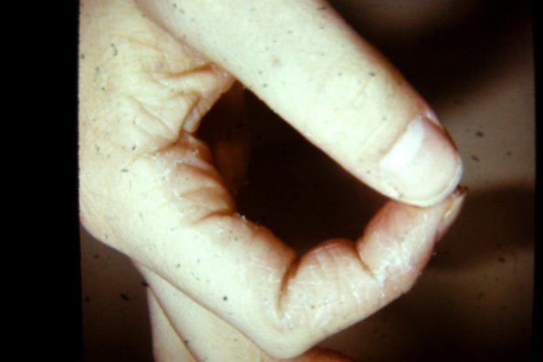 Keratoderma Palmaris (9)