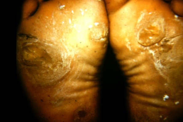 Keratoderma Plantare