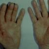 Keratoderma blenorrhagica after Rx