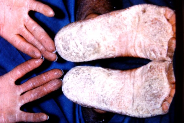 Keratosis Palmaris