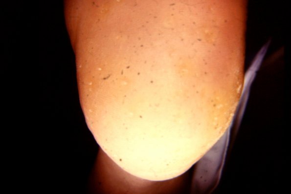 Keratosis Punctata