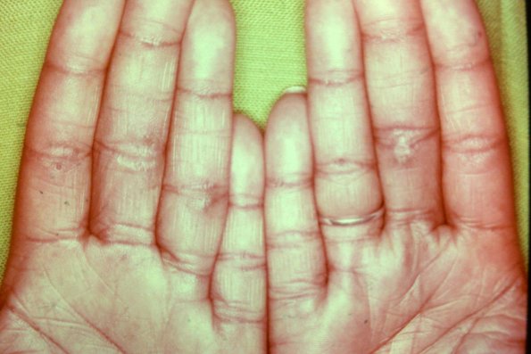 Palmar Porokeratosis