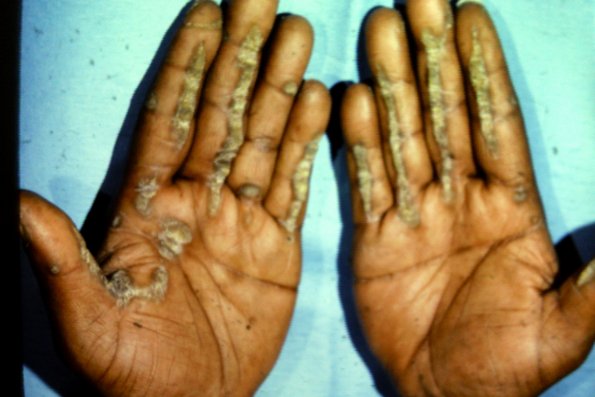 Palmar Striate Keratoderma