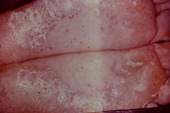 Keratosis Blenorrhagica