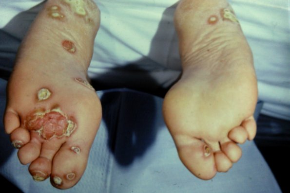 Pustular psoriasis keratosis blenorrhagica