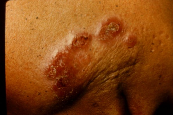 Leishmaniasis (29)