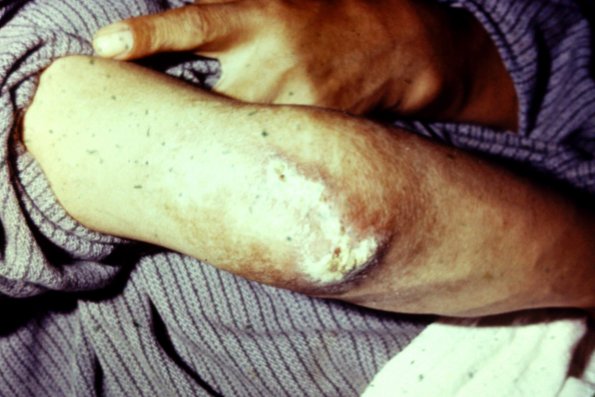 Leishmaniasis (5)