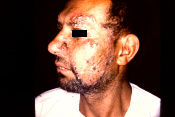 Leishmaniasis (7)