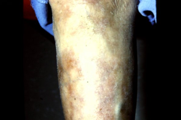 Lepromatous Leprosy (3)