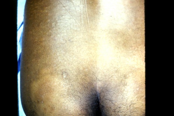 Leprosy indeterminate (3)
