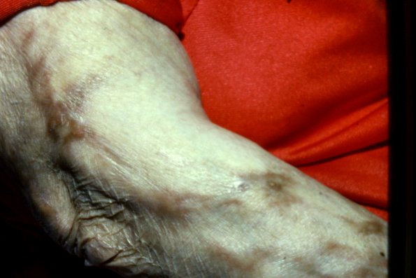 lepomatons Leprosy (2)