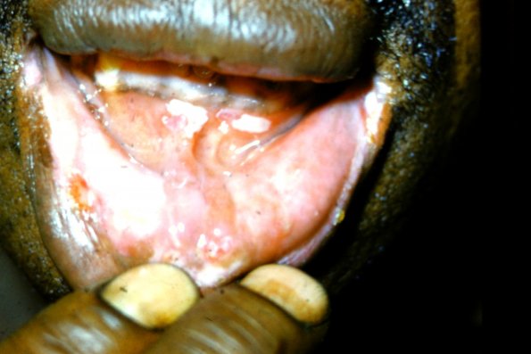 Mouth Lesions (2)