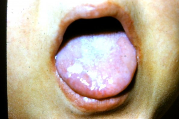 Leukokeratosis osis