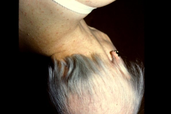 Follicular Lichen Planus