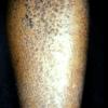 Lichen Amyloidosis (2)